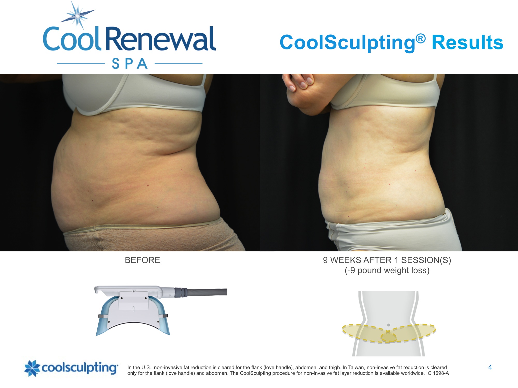 coolsculpting before and after photo