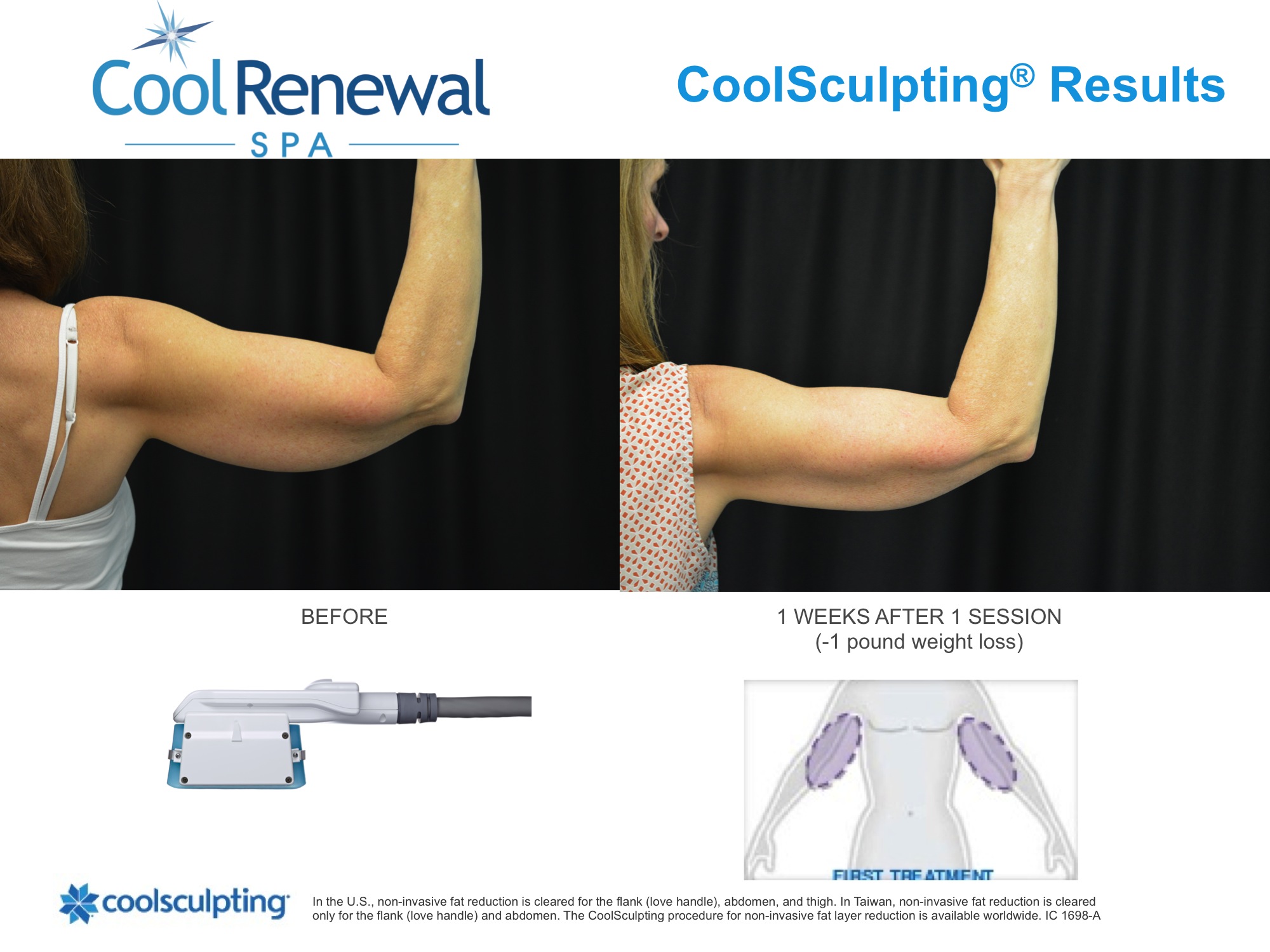 coolsculpting before and after photo