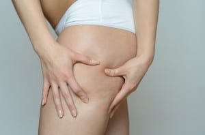 Liposuction Alternative