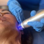 Pigment Laser Rejuvenation Treatment