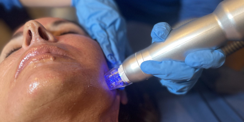 Pigment Laser Rejuvenation Treatment in Charlotte, North Carolina